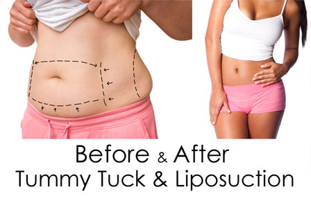 Tummy Tuck surgery - Abdominal